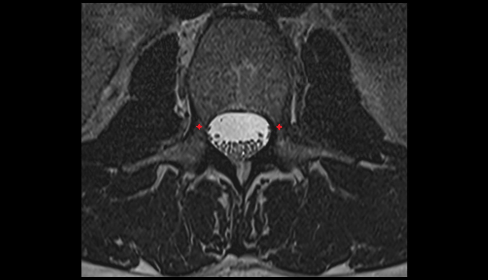 Pedicle of vertebra axial image