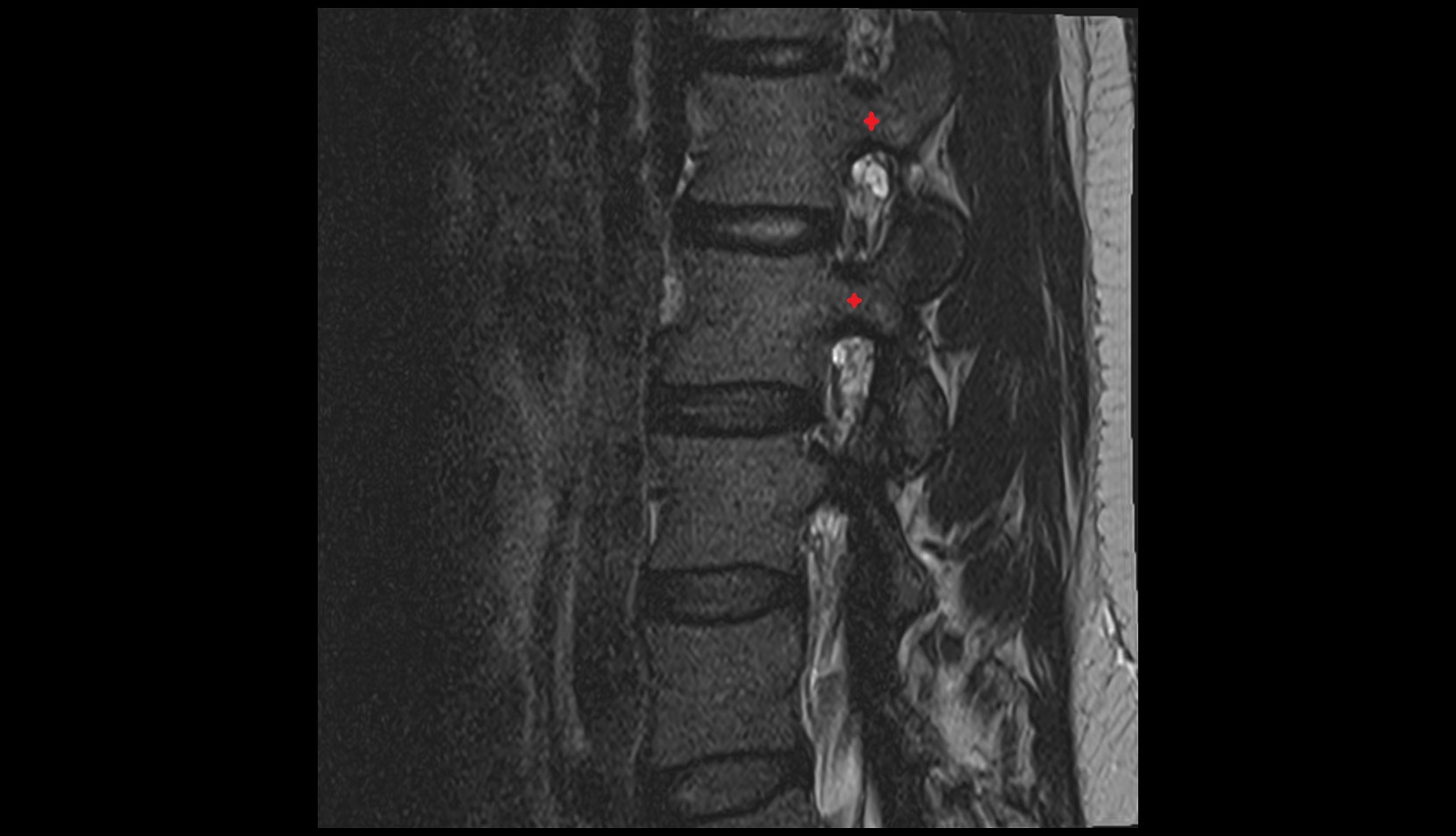 Pedicle of vertebra sag image