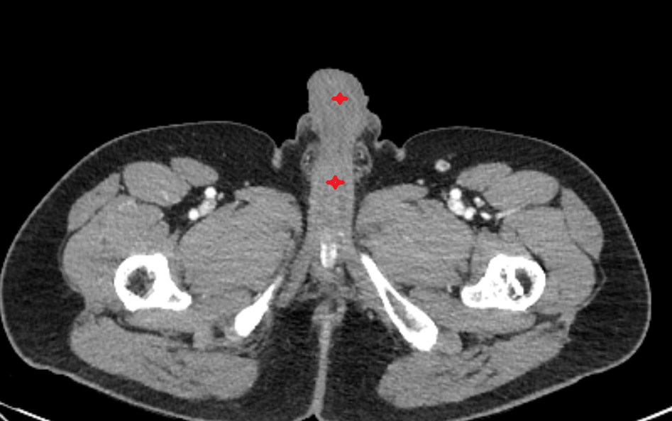 Penis  CT  anatomy  Location and Imaging Appearance  -img-00000-00000