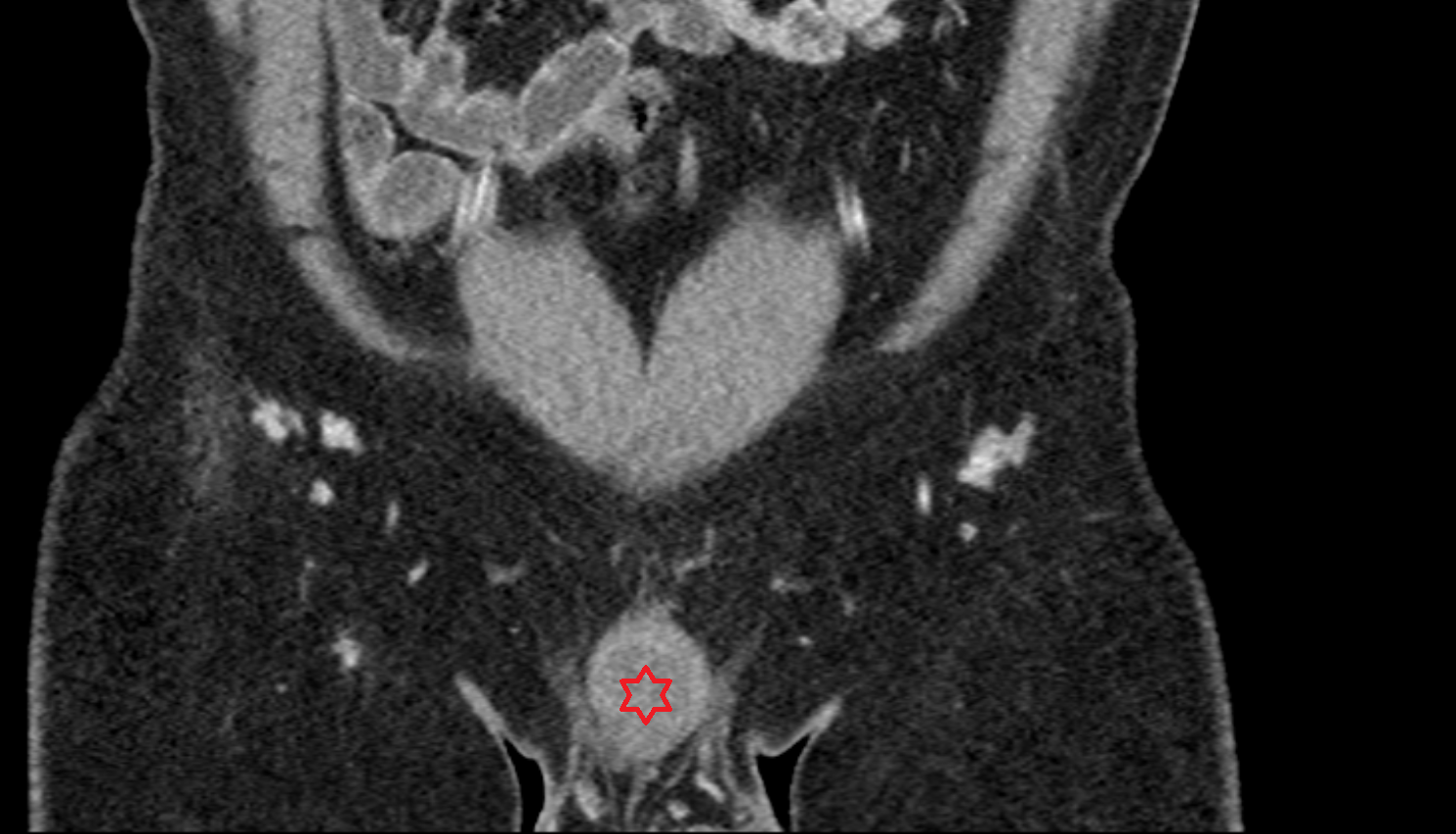 Penis  CT  anatomy  Location and Imaging Appearance  -img-00000-00000_00001