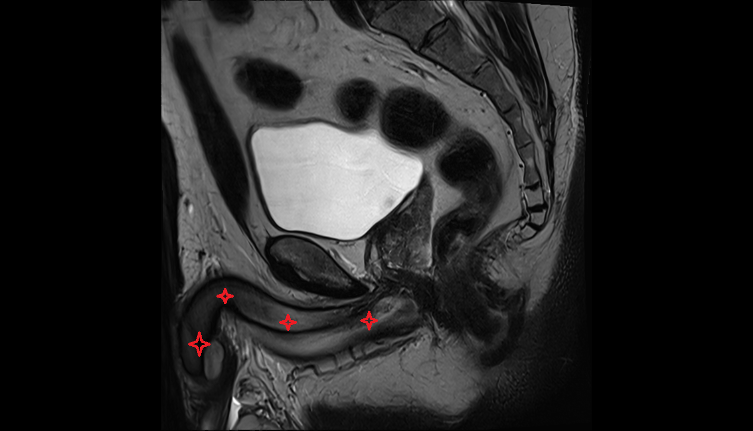 Penis  MRI  anatomy  Location and Imaging Appearance  -img-00000-00000