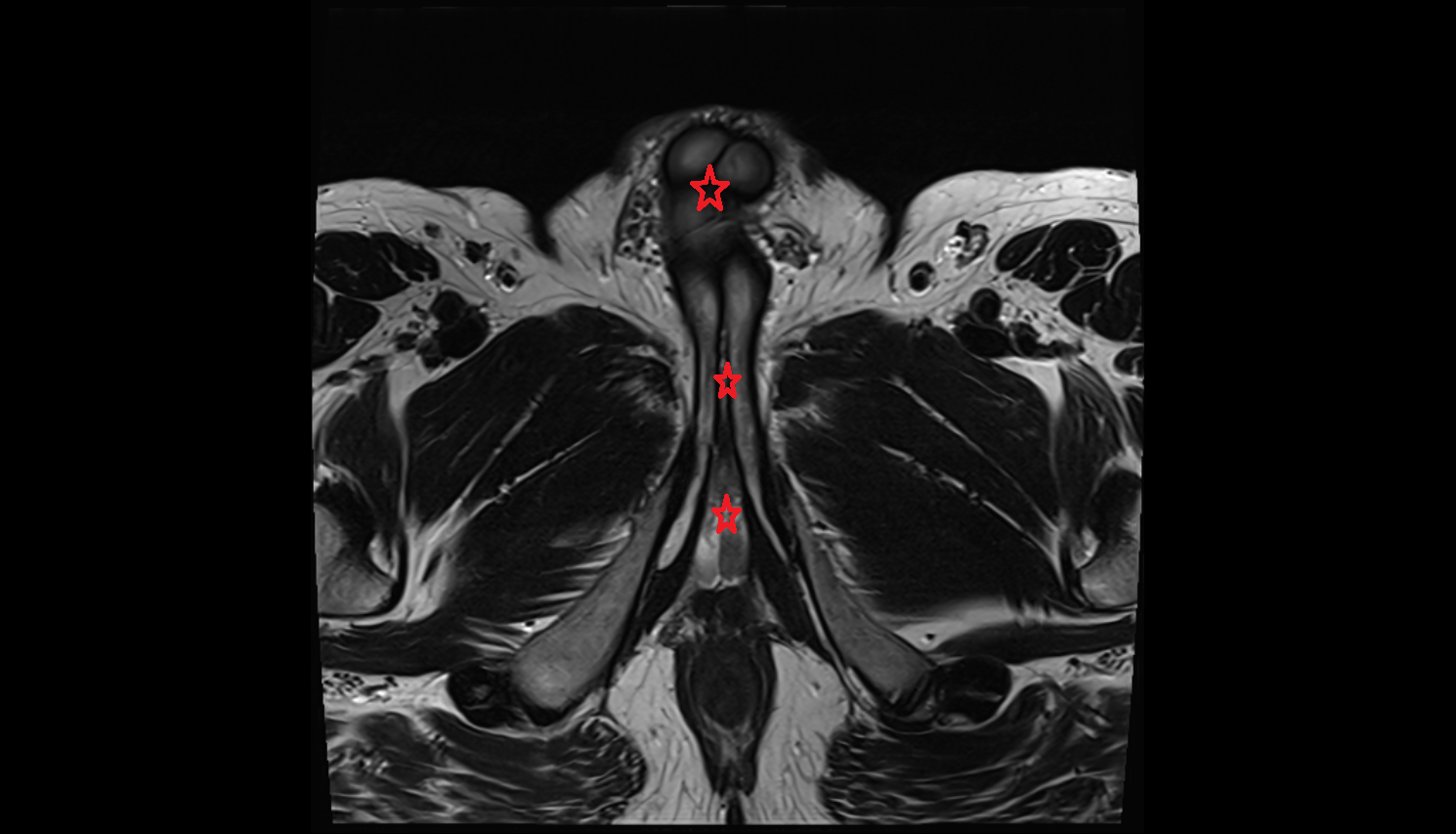 Penis  MRI  anatomy  Location and Imaging Appearance  -img-00000-00000_00001