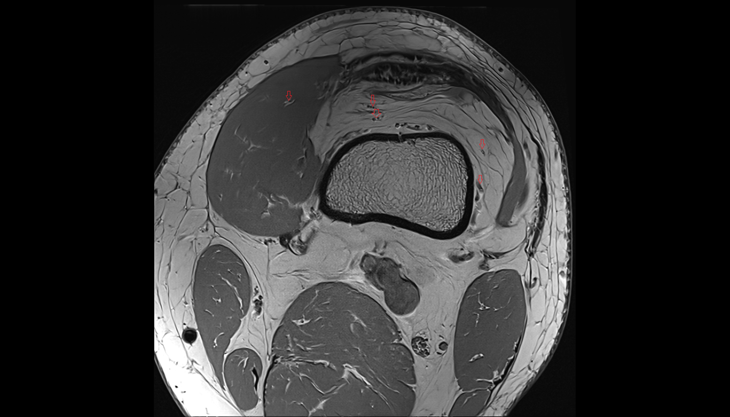 Perforating Arteries (Knee Joint)  MRI  axial  cross sectional anatomy 3T MRI AI enhanced  radiology  anatomy image-img-00000-00000