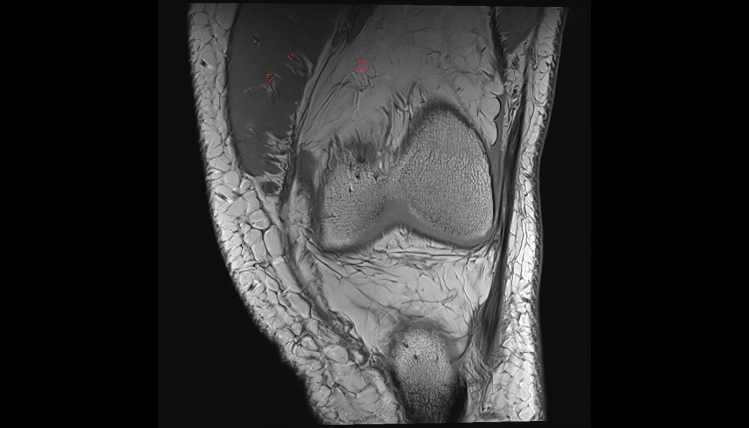Perforating Arteries (Knee Joint)  MRI  coronal  cross sectional anatomy 3T MRI AI enhanced  radiology  anatomy image-img-00000-00000