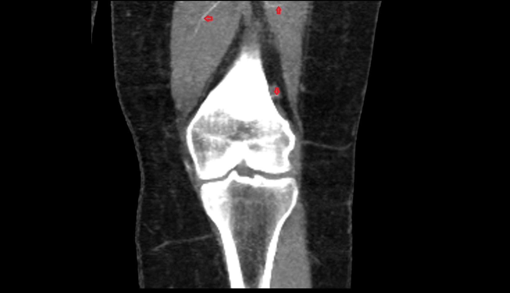 Perforating Arteries (Knee Joint) ct coronal