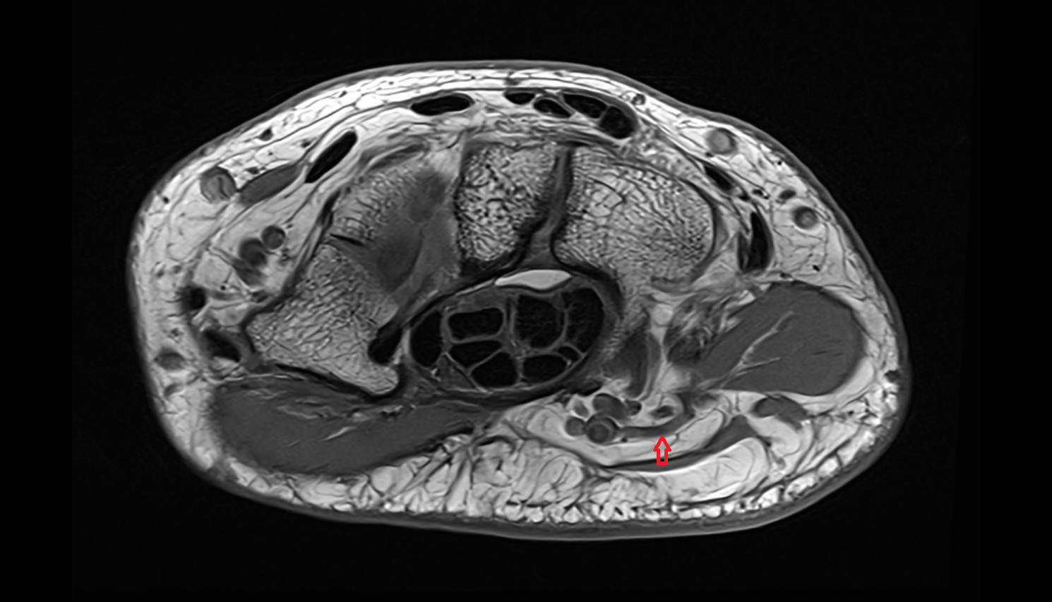 Perforating branches of ulnar vein  axial cross sectional anatomy 3T MRI AI enhanced radiology image-img-00000-00000