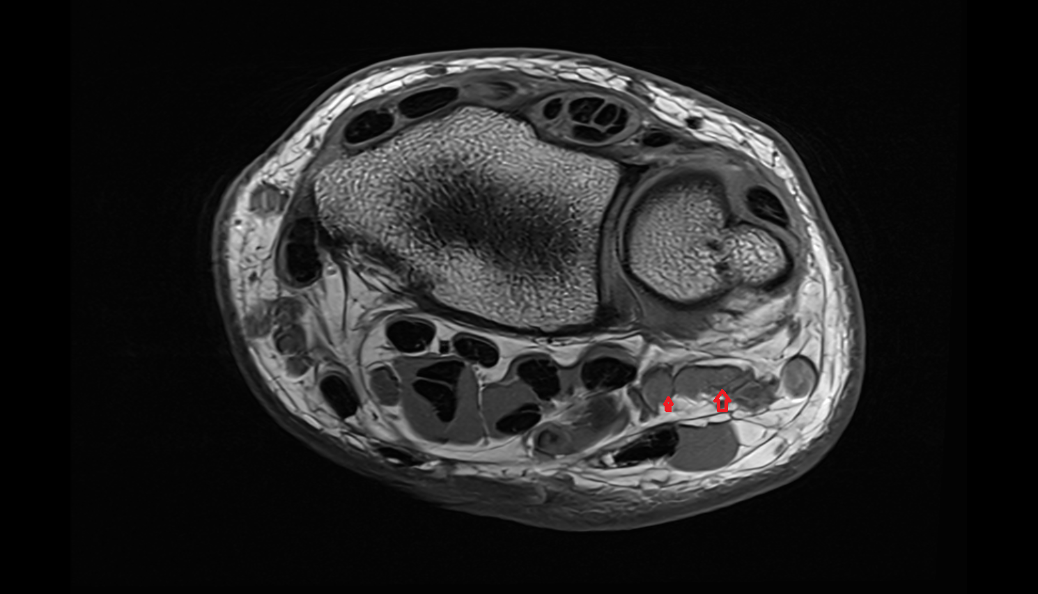 Perforating branches of ulnar vein  axial cross sectional anatomy 3T MRI AI enhanced radiology image-img-00000-00000_00001