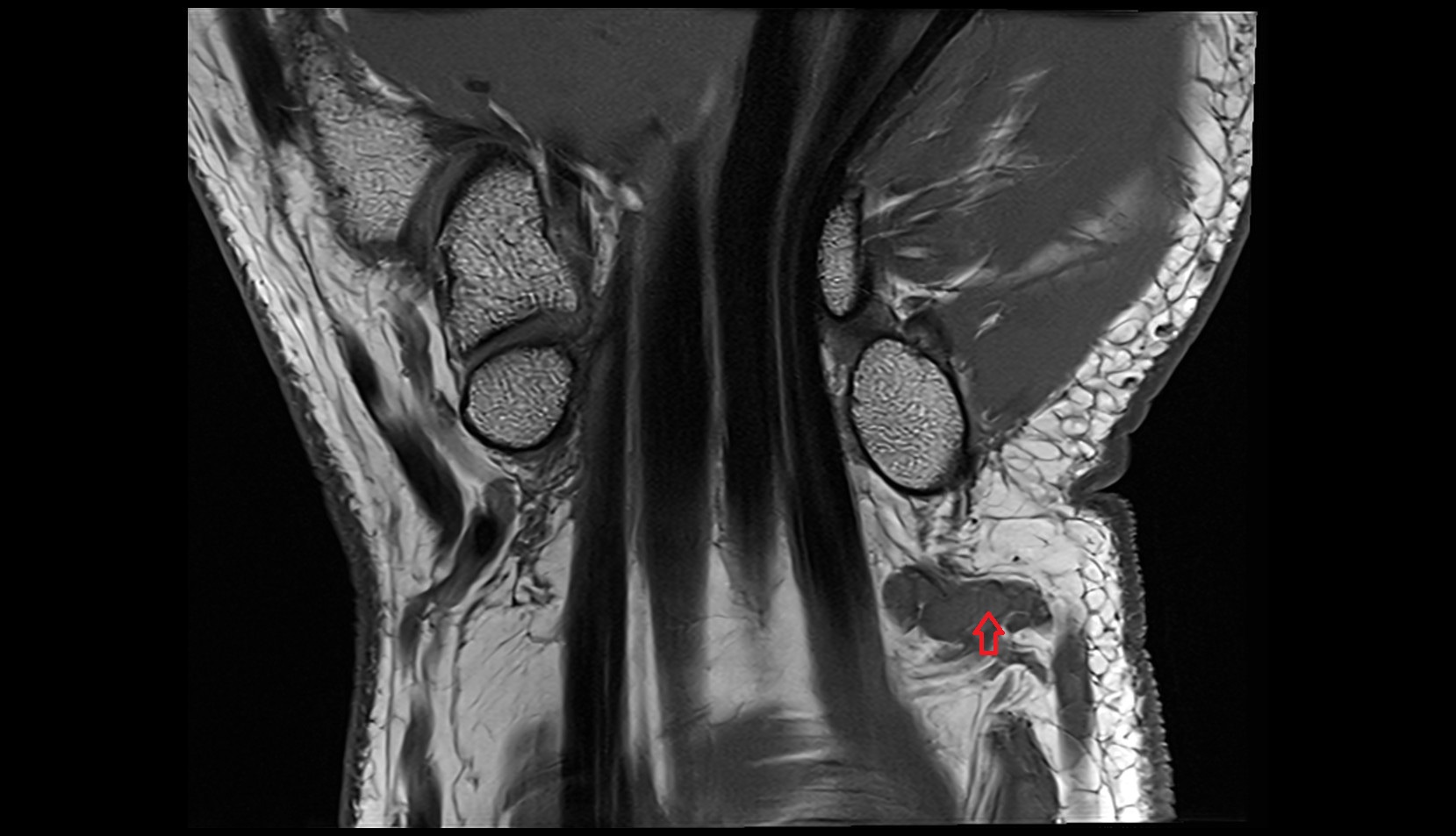 Perforating branches of ulnar vein coronal