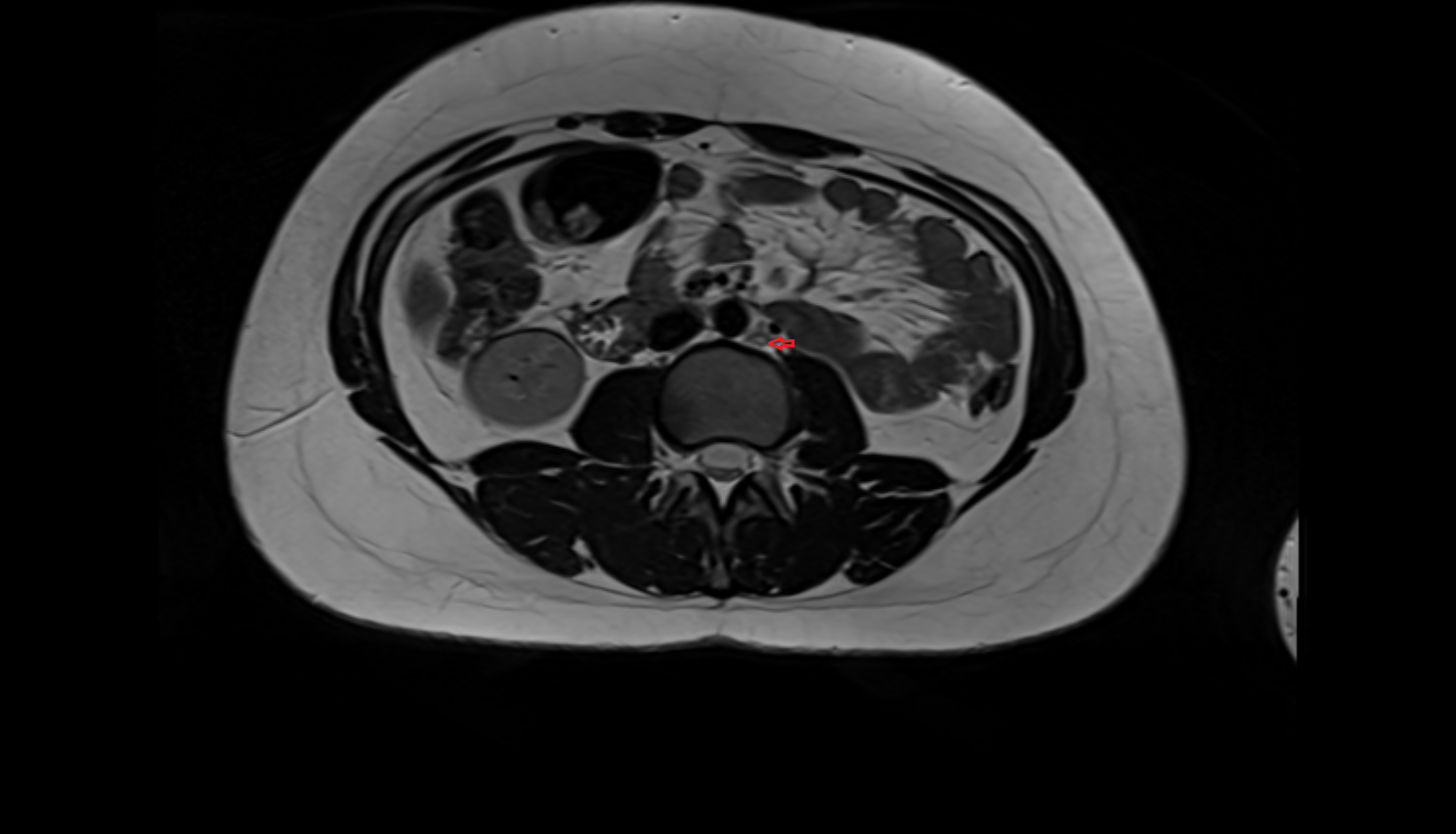 Periaortic lymph nodes  MRI  axial  image-img-00000-00000