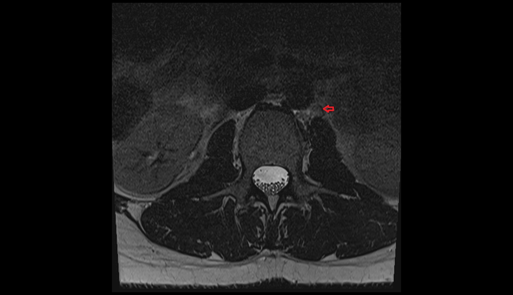 Periaortic lymph nodes mri axial image 1