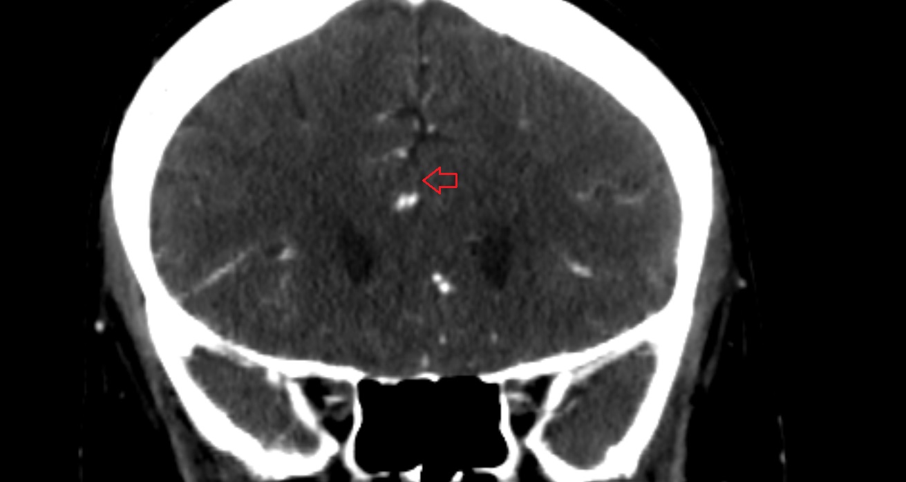 Pericallosal cistern  CT coronal anatomy image -img-00001-00001
