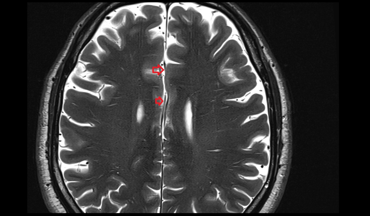 Pericallosal cistern mri 3t axial image