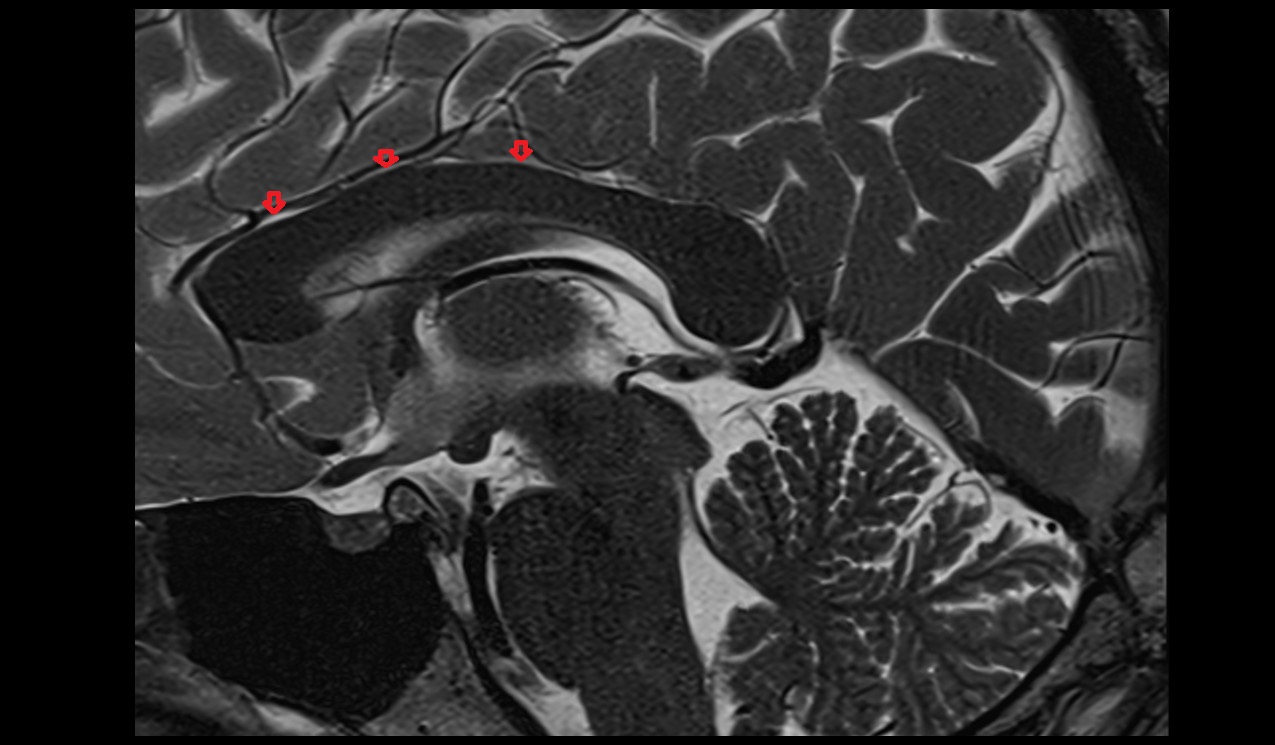 Pericallosal cistern mri 3t sagittal image