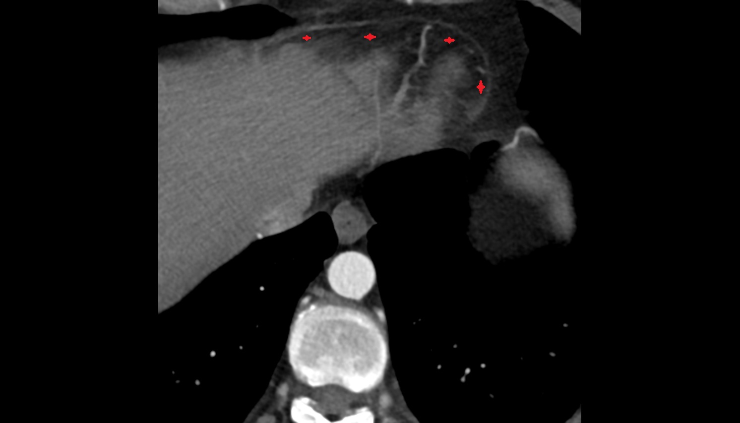 Pericardial cavity  anatomy CT axial image -img-00000-00000