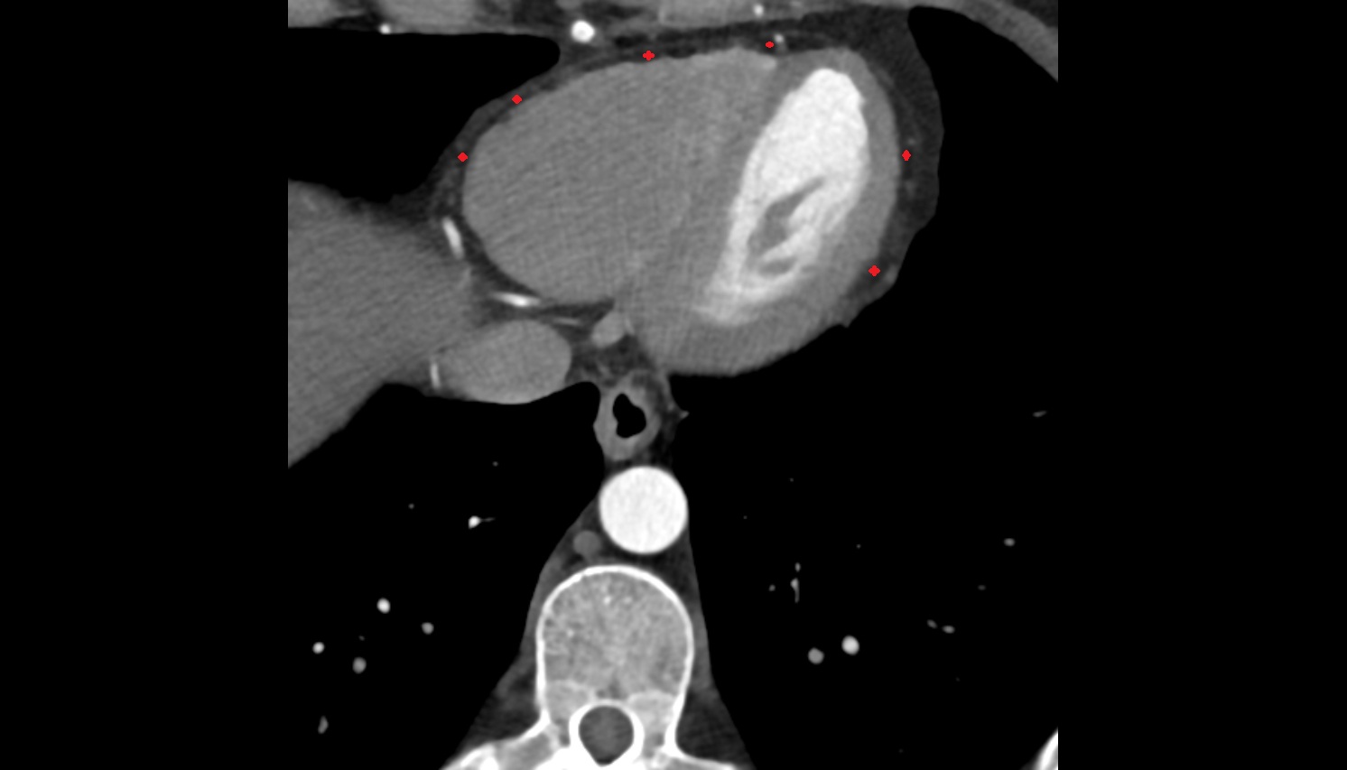 Pericardial cavity  anatomy CT axial image -img-00000-00000_00001