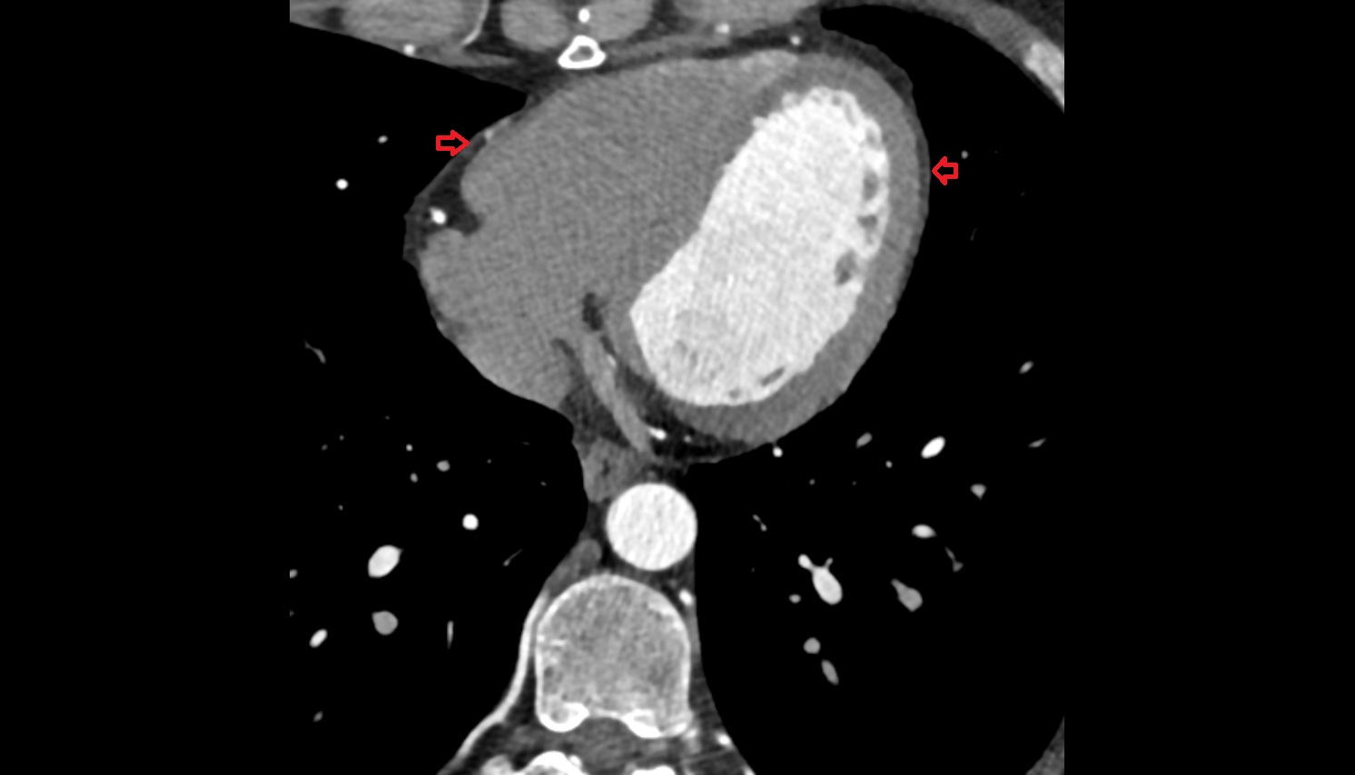 Pericardium CT AXIAL image -img-00000-00000