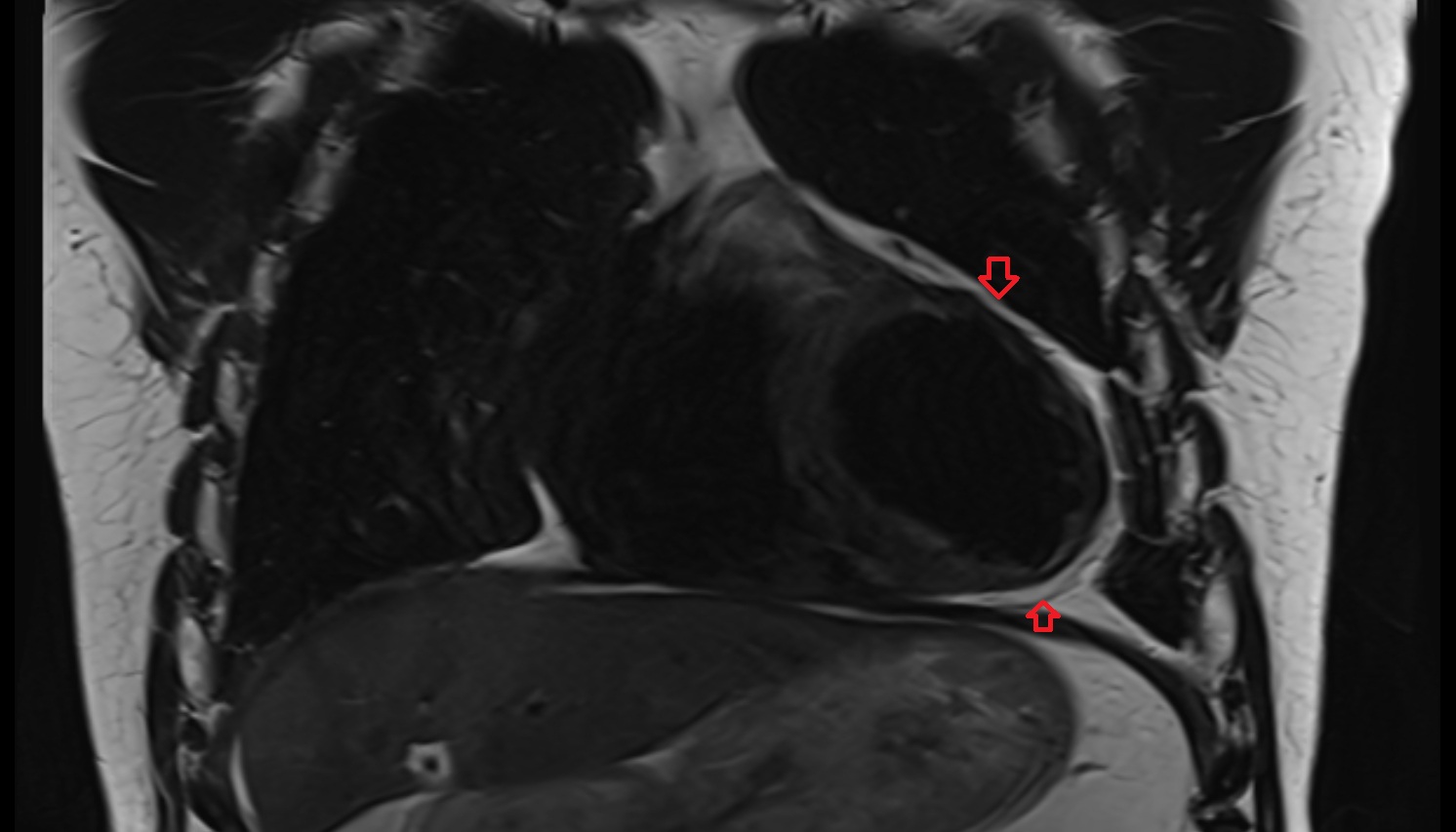 Pericardium MRI coronal  image -img-00000-00000
