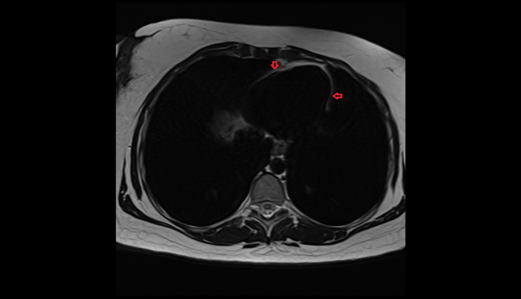 Pericardium mri axial image