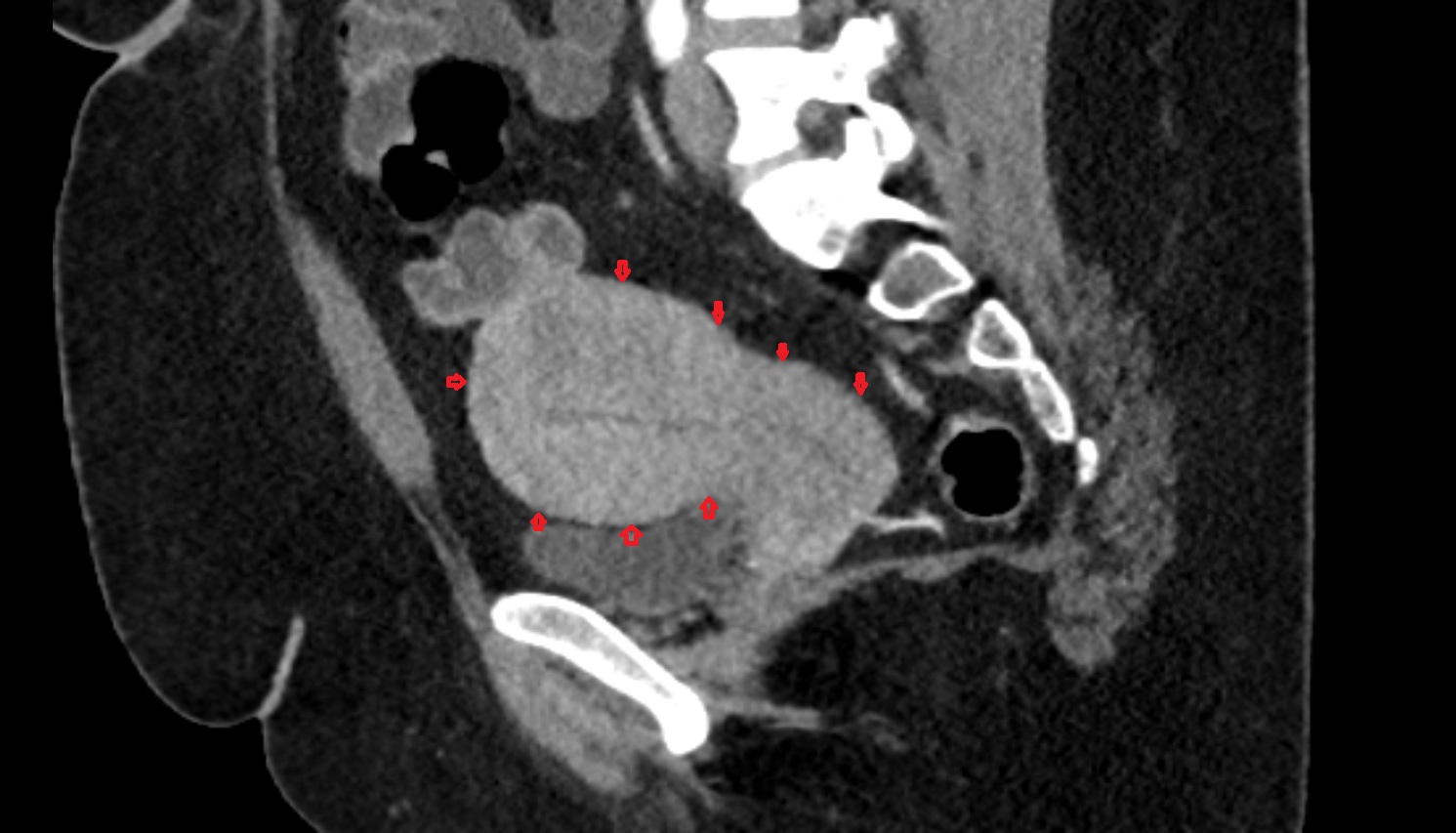 Perimetrium of uterus CT  sagittal  image anatomy  image-img-00000-00000