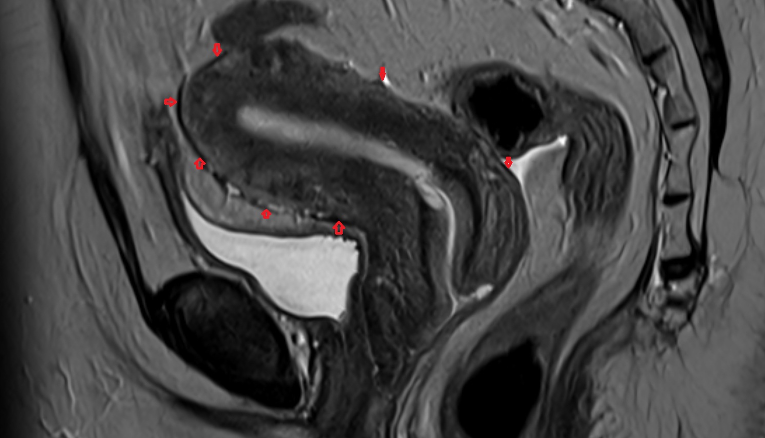 Perimetrium of uterus  MRI  sagittal  image anatomy  image-img-00000-00000