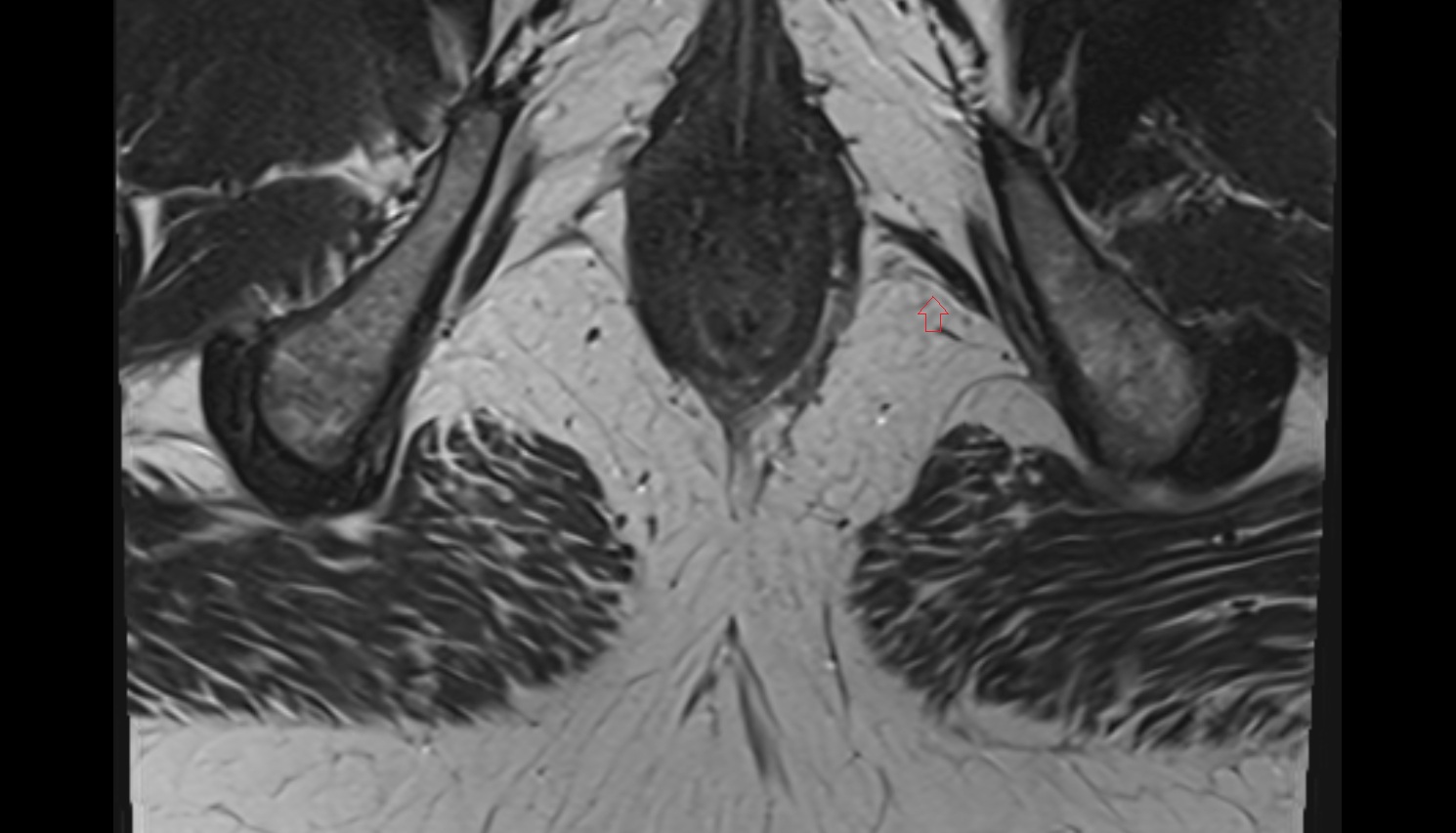 Perineal nerves  mri axial  anatomy  image-img-00000-00000