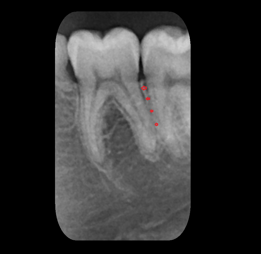 Periodontal ligament
