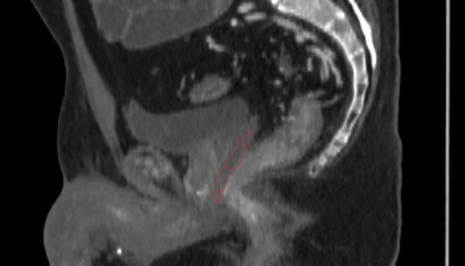 Peripheral zone of prostate    CT sagittal  anatomy  image