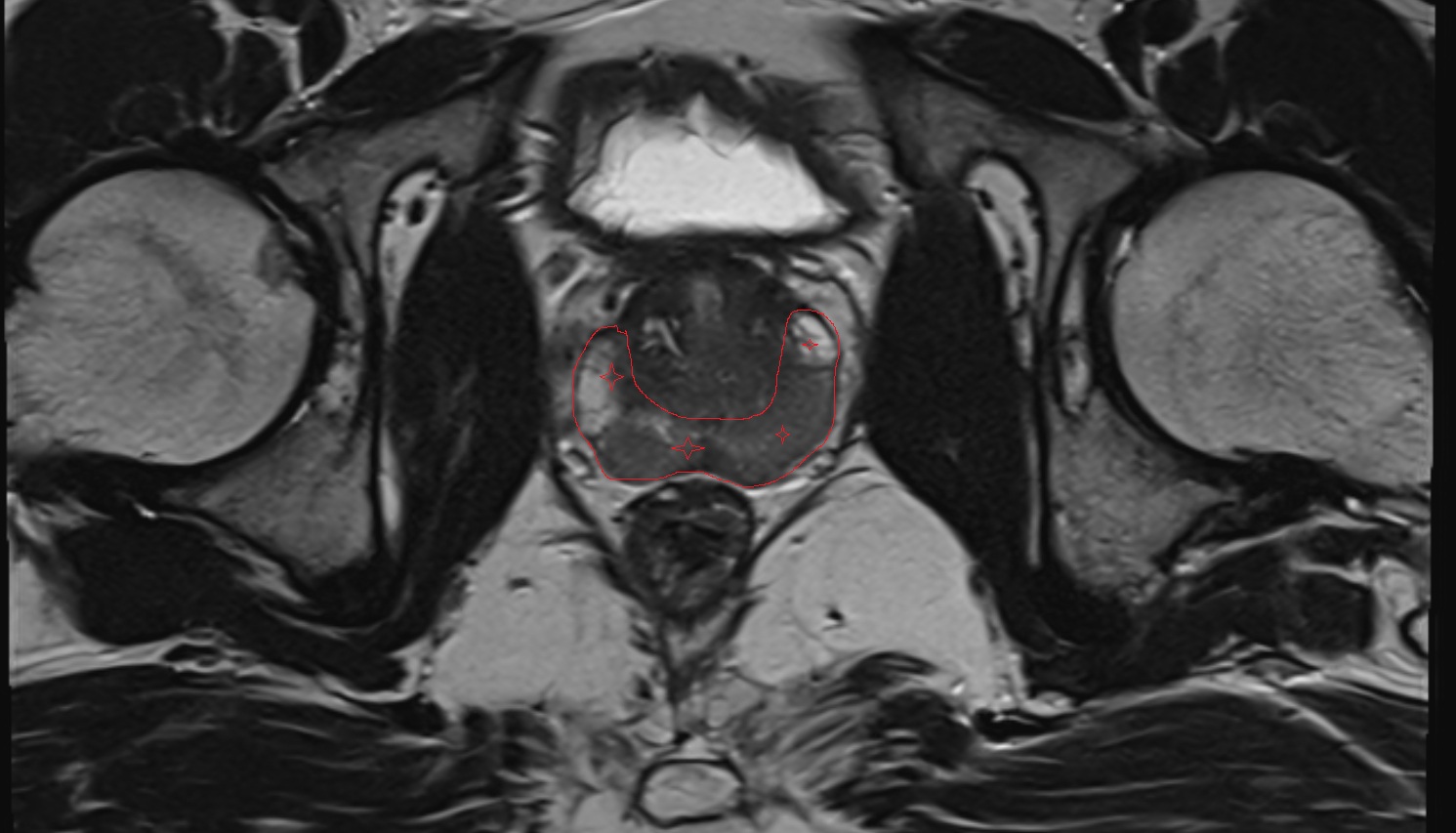 Peripheral zone of prostate   MRI axial  anatomy  image-img-00000-00000