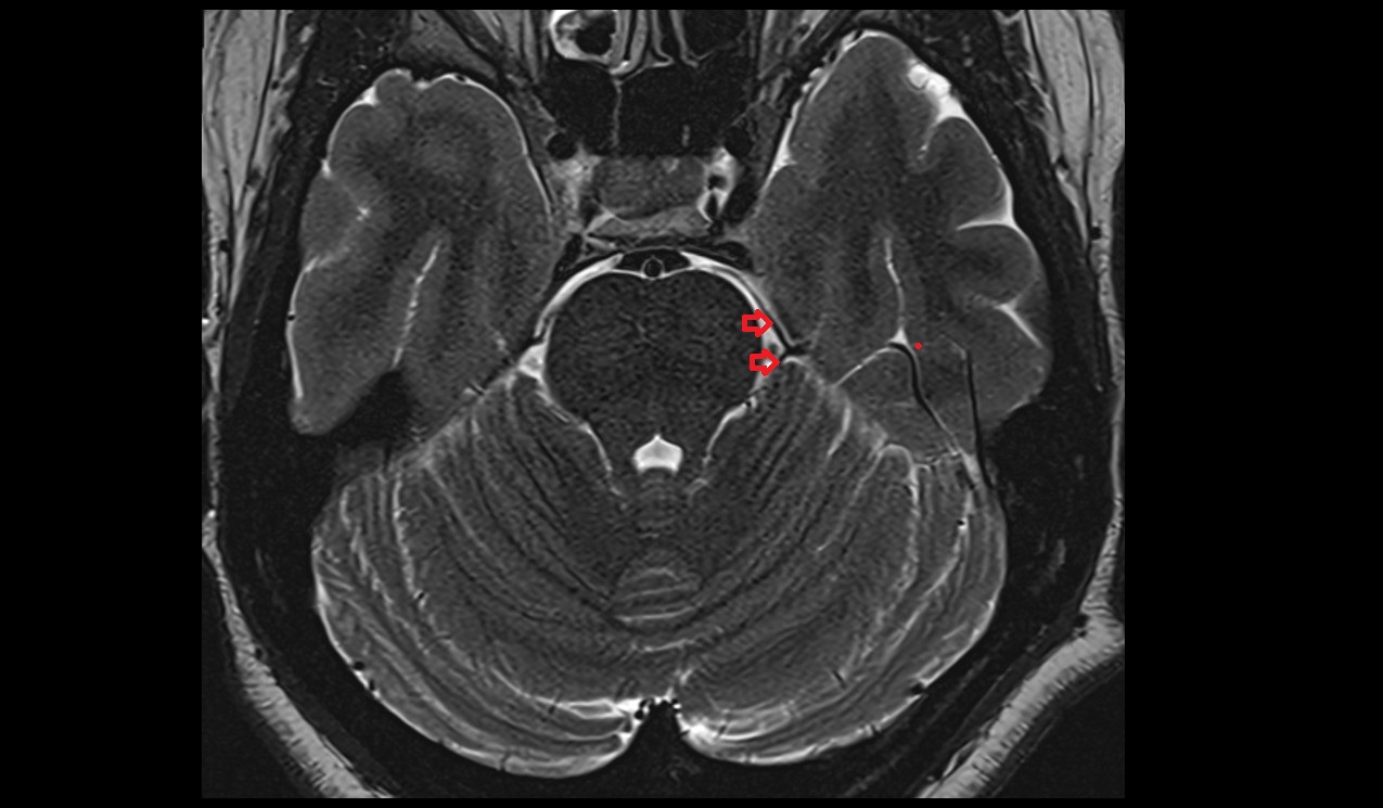 Petrosal vein MRI 3T axial  image