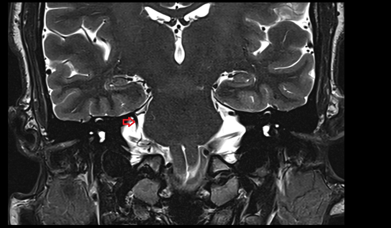 Petrosal vein MRI 3T coronal image