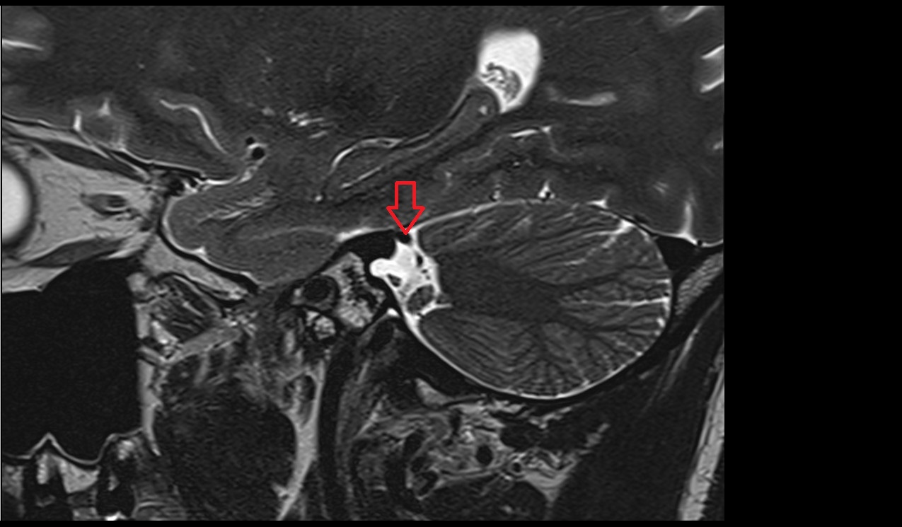 Petrosal vein MRI 3T sagittal image
