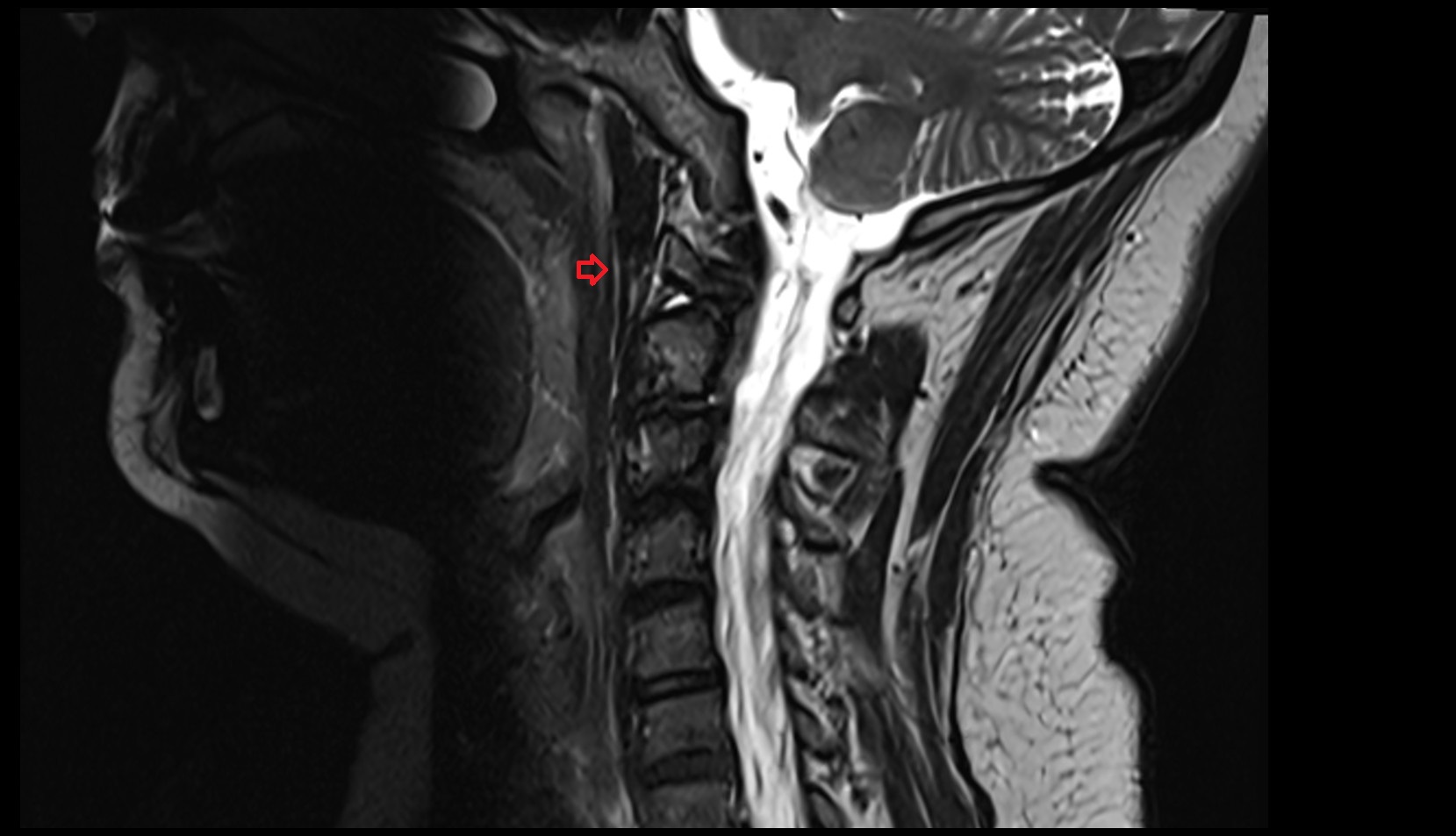Pharyngeal raphe sag image