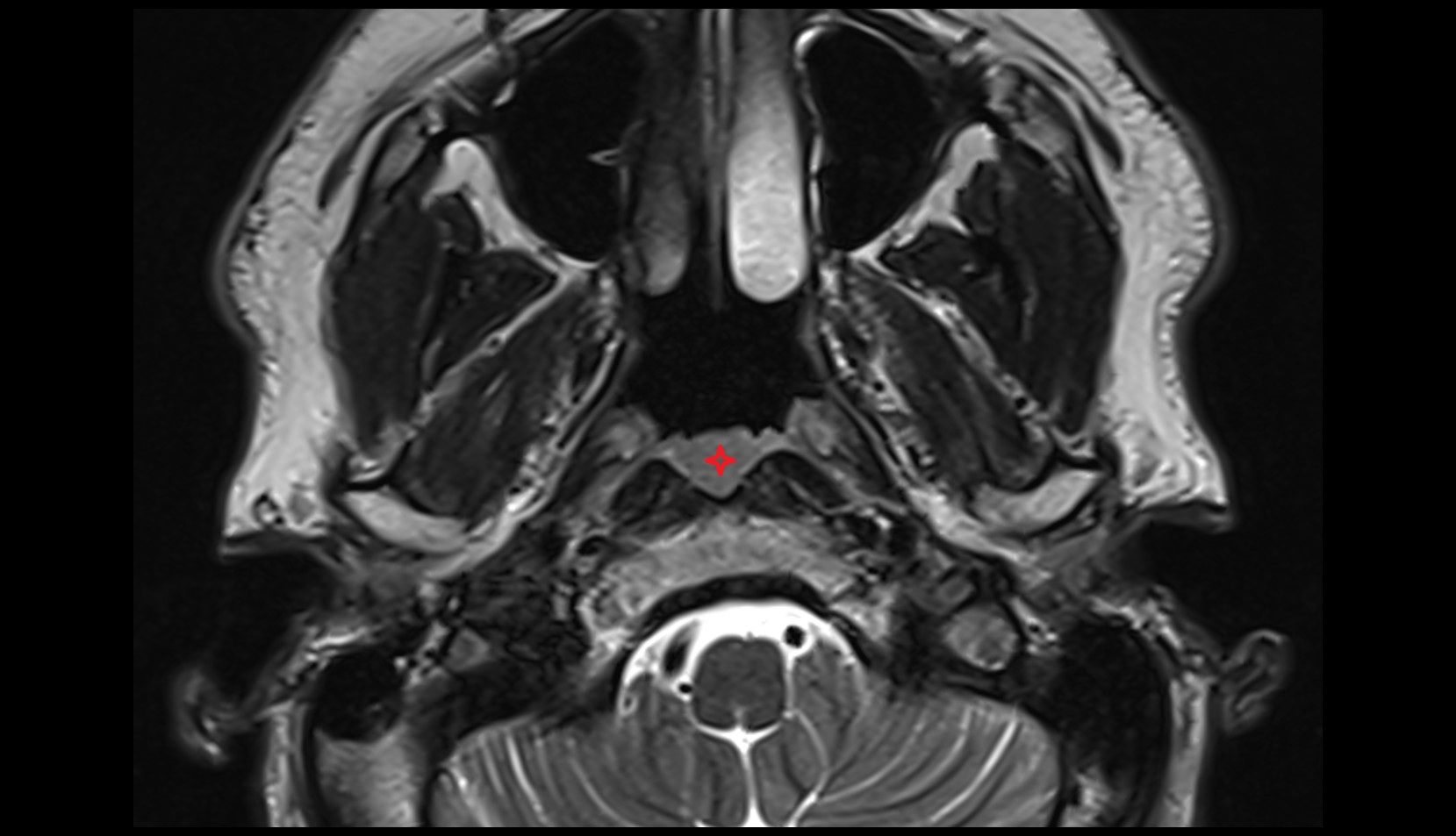 Pharyngeal tonsil MRI axial image