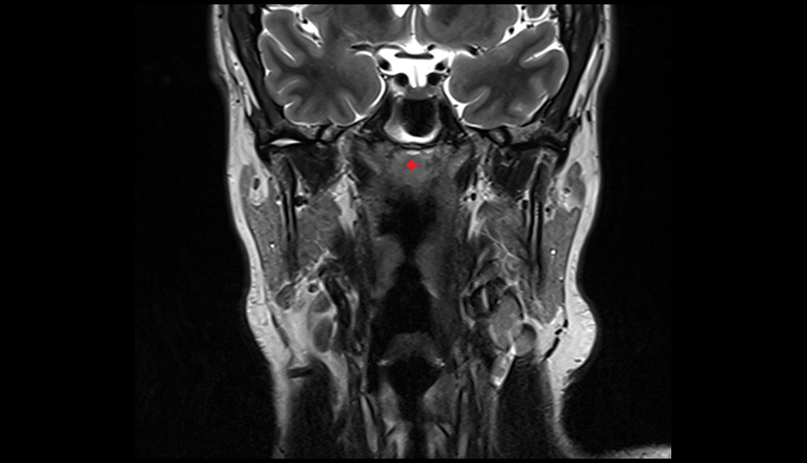 Pharyngeal tonsil MRI coronal image