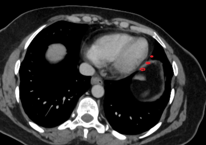Phrenicomediastinal recess  CT axial  image anatomy  image -img-00000-00000