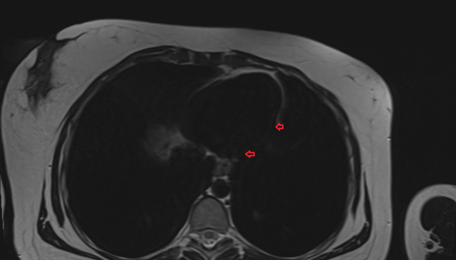 Phrenicomediastinal recess  MRI axial  image anatomy  image -img-00000-00000