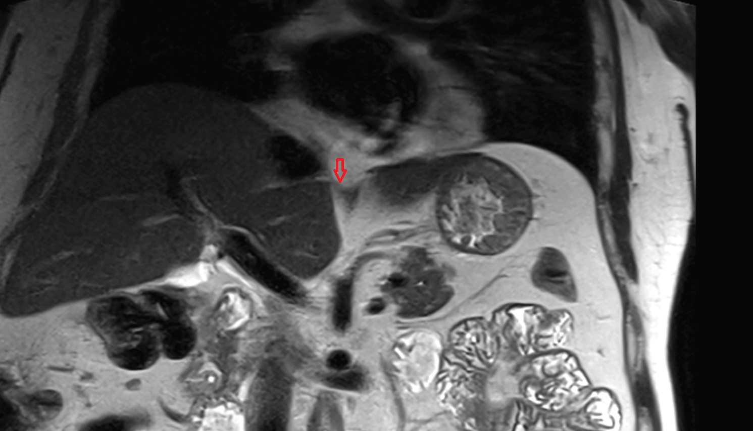 Phrenoesophageal ligament   MRI axial  image anatomy  image -img-00000-00000