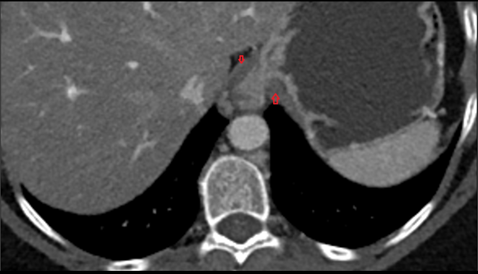 Phrenoesophageal ligament ct axial image