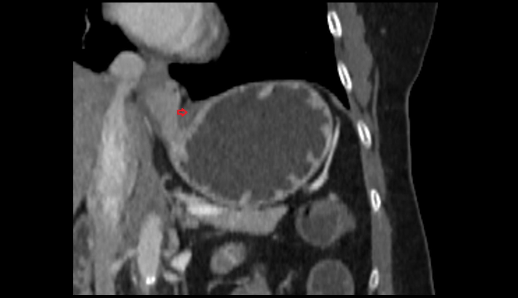 Phrenoesophageal ligament ct  coronal image