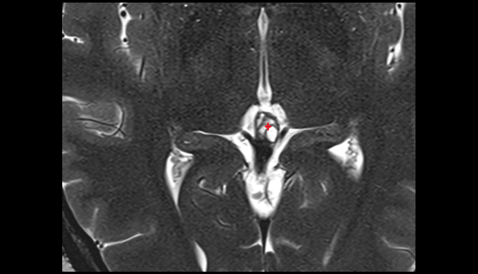 Pineal gland AXIAL IMAGE
