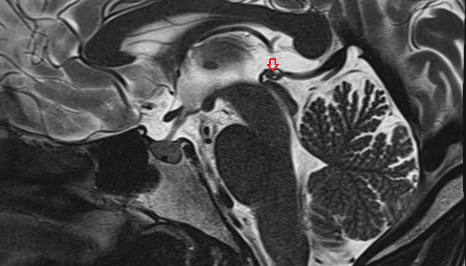 Pineal gland mri sag  image -img-00000-00000