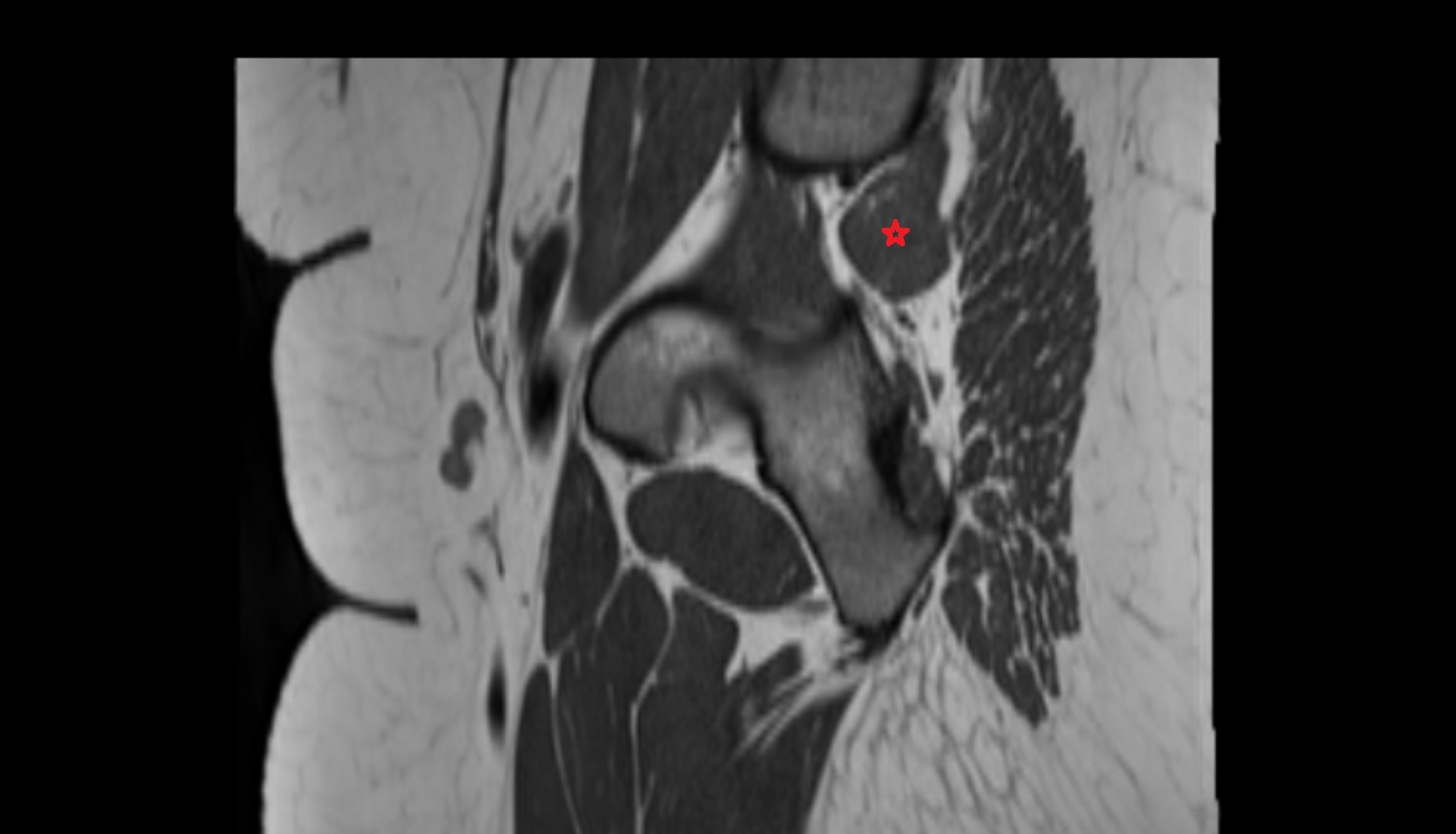 Piriformis muscle  MRI sag anatomy image-img-00000-00000