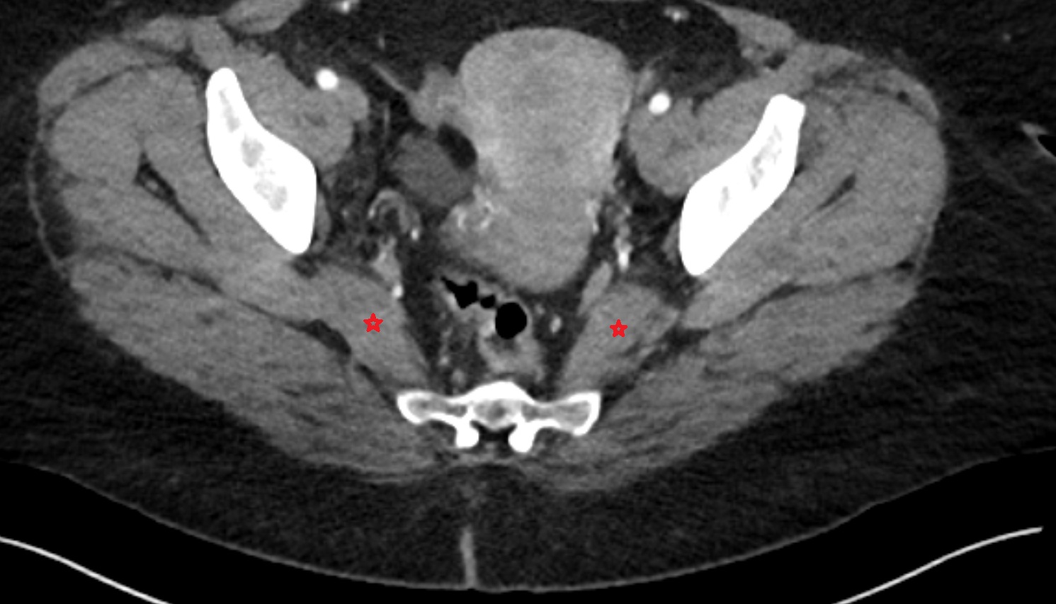 Piriformis muscle  ct  axial image  image anatomy  image-img-00000-00000