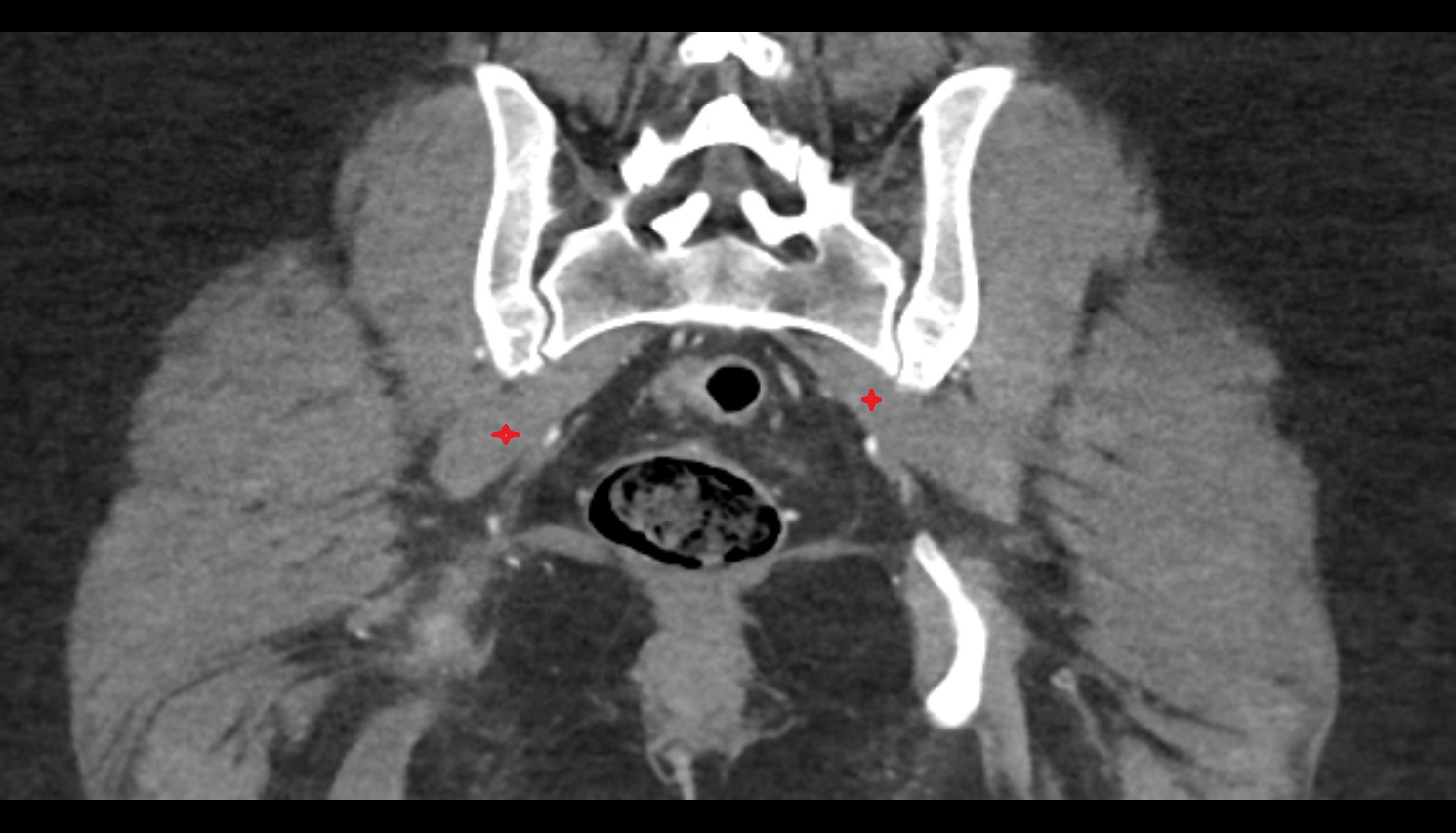 Piriformis muscle  ct  coronal  image  image anatomy  image-img-00000-00000