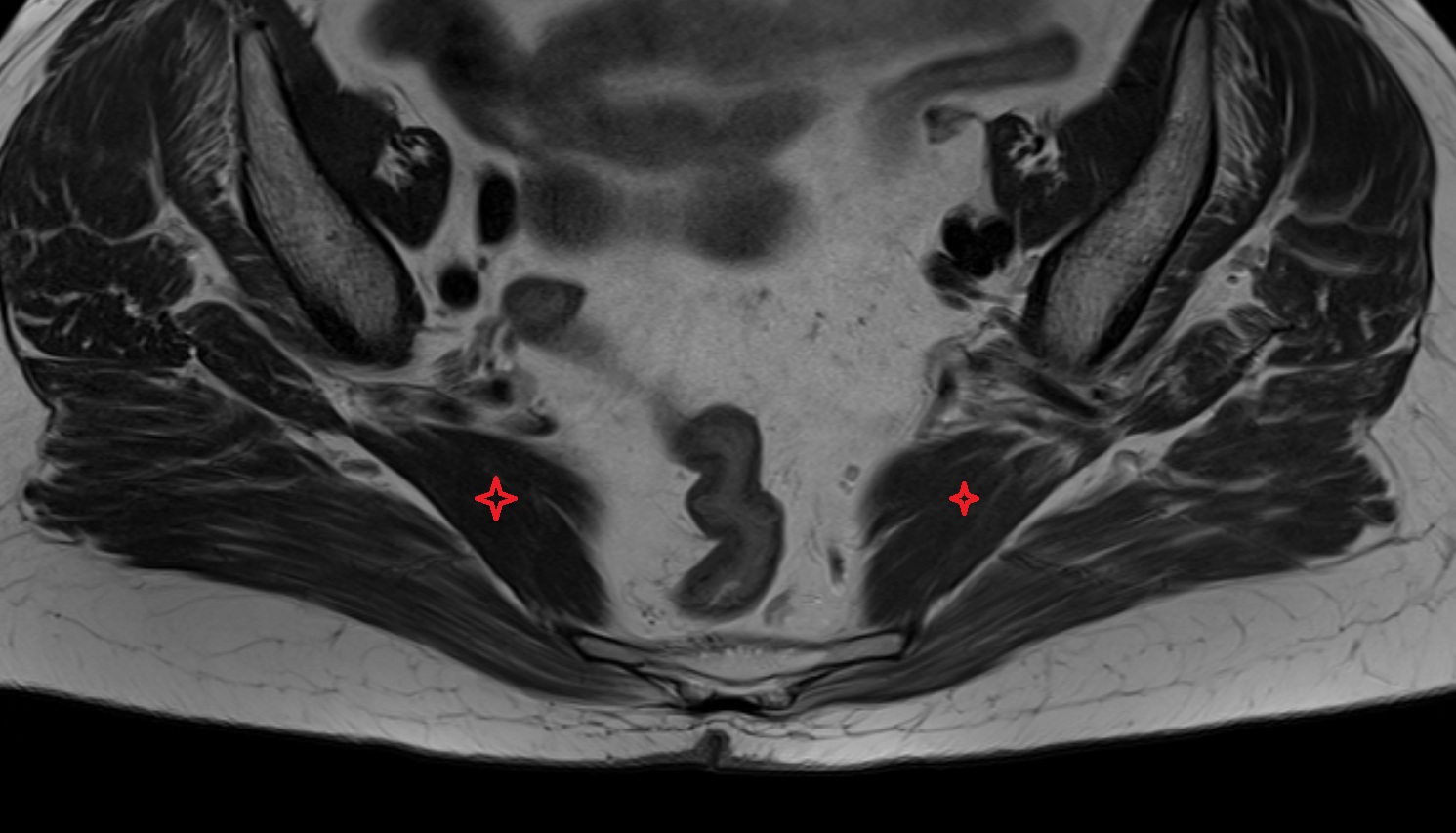 Piriformis muscle  mri axial image  image anatomy  image-img-00000-00000