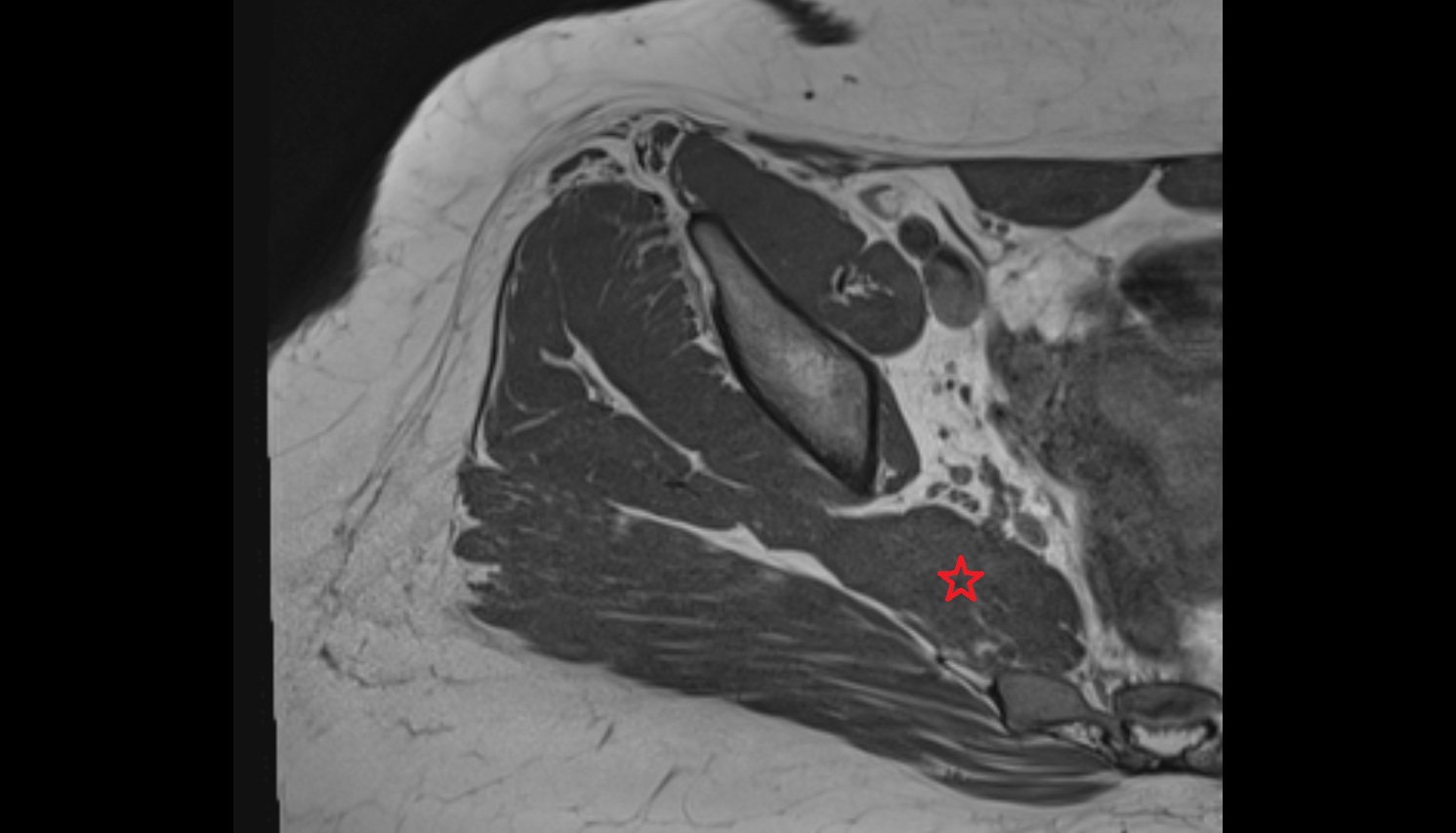Piriformis muscle  mri axial image  image anatomy  image-img-00000-00000_00001