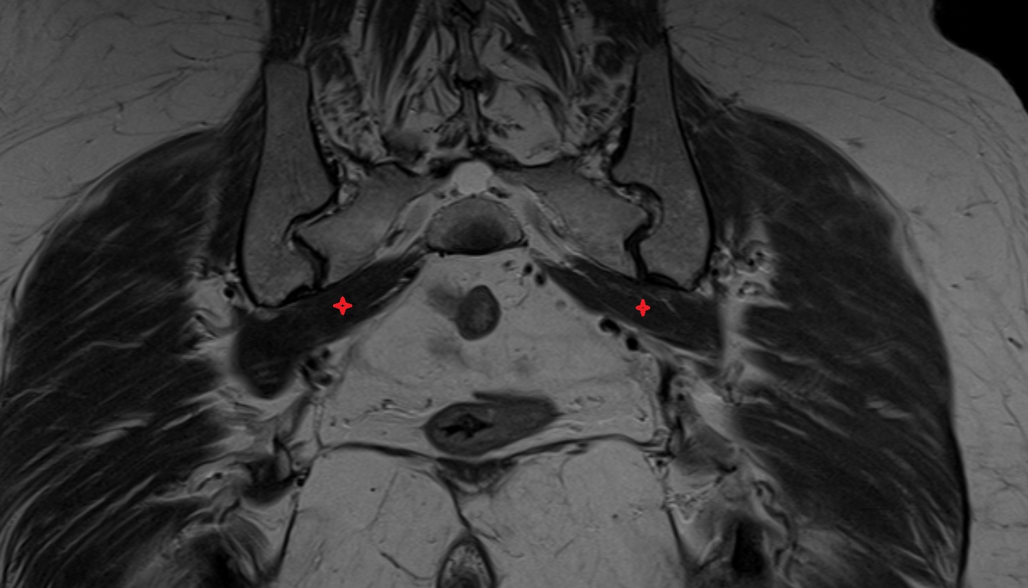 Piriformis muscle  mri coronal  image  image anatomy  image-img-00000-00000