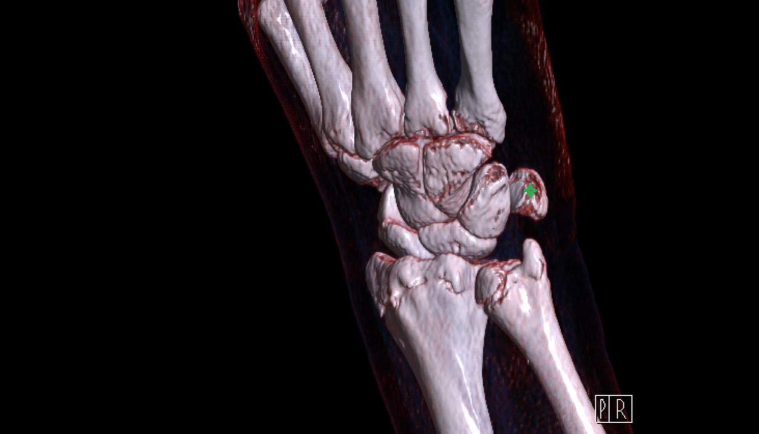 Pisiform bone CT 3D VRT image -img-00000-00000