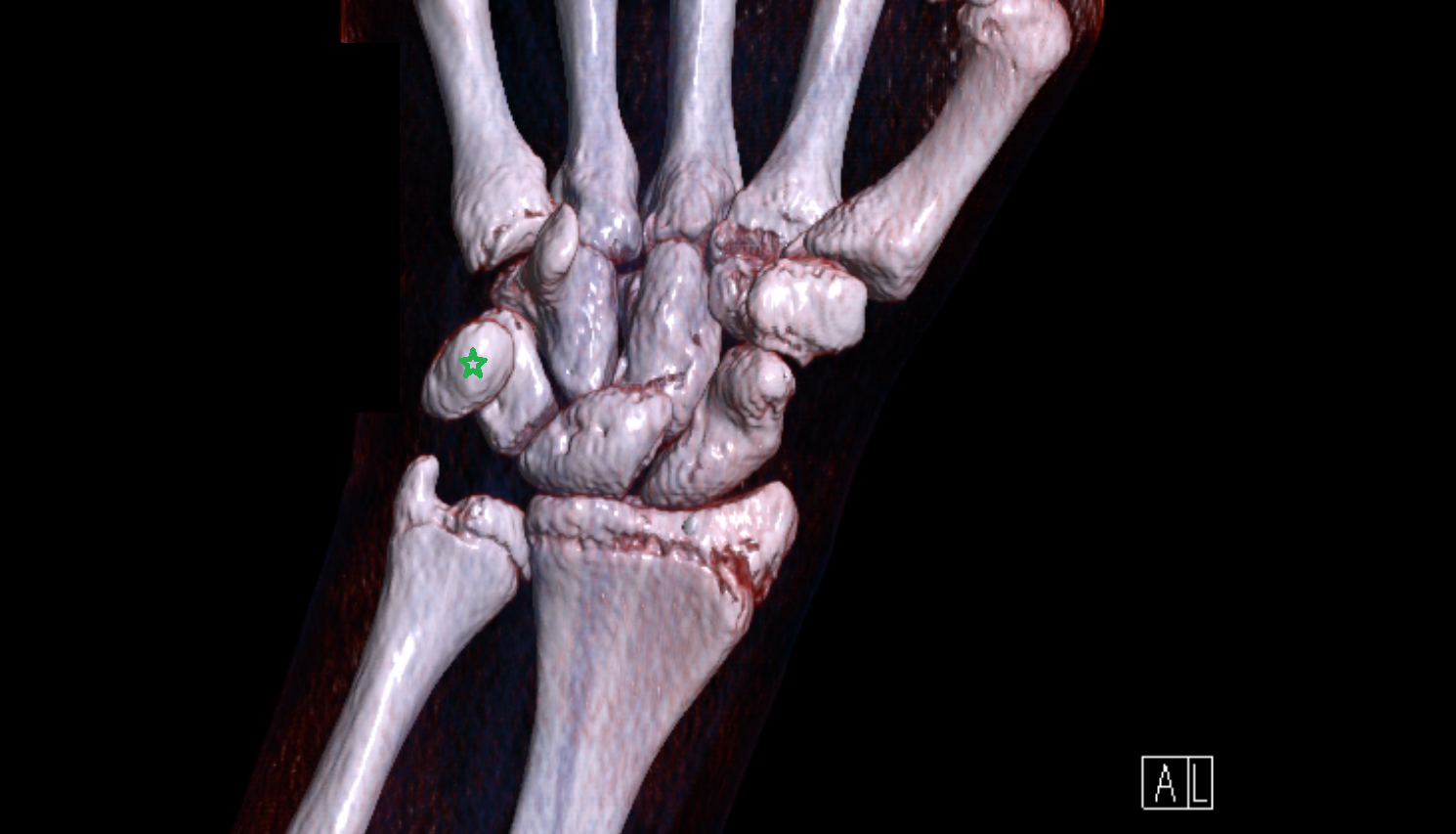 Pisiform bone CT 3D VRT image -img-00000-00000_00001