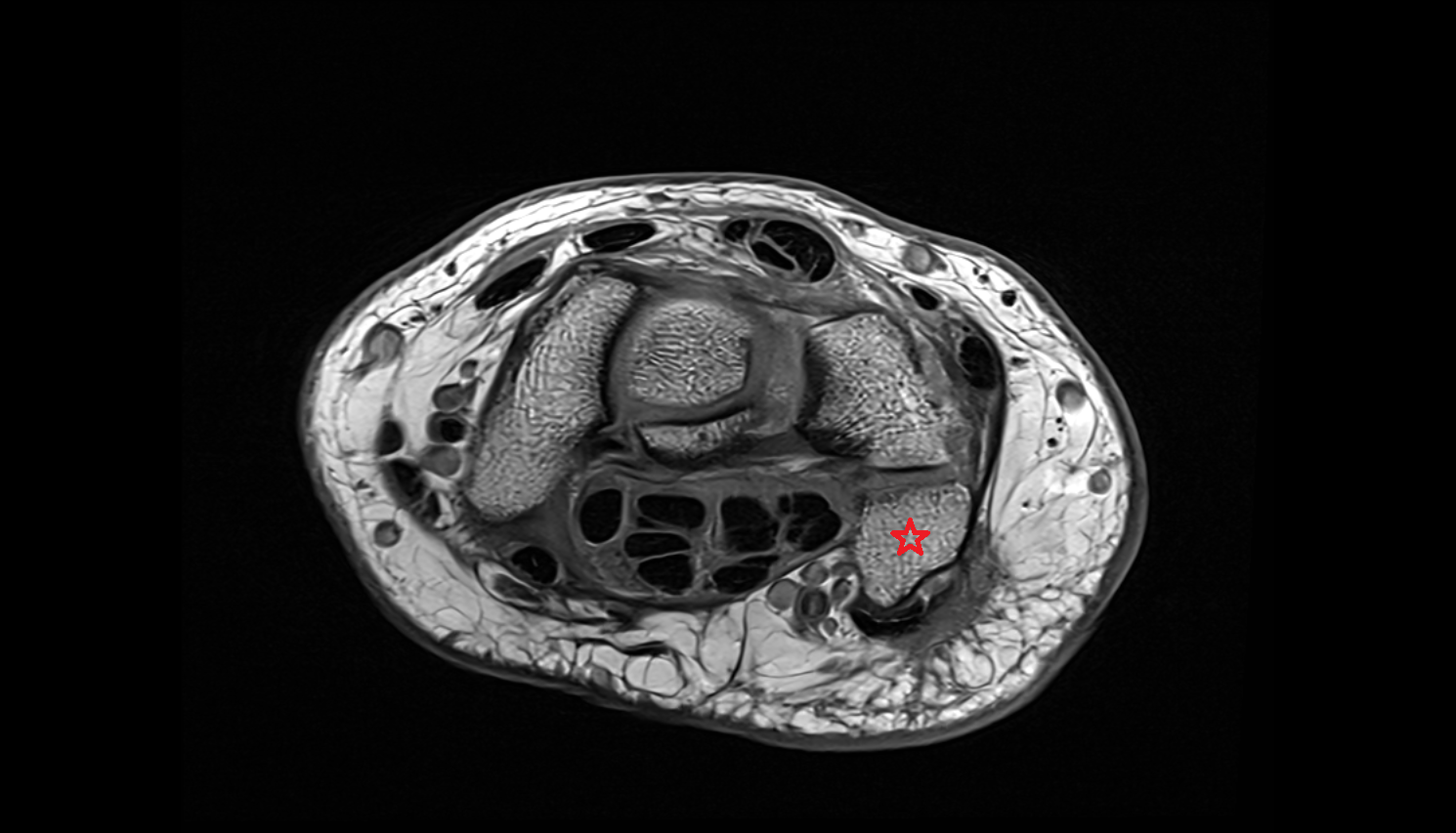 Pisiform bone axial cross sectional anatomy 3T MRI AI enhanced radiology image-img-00000-00000